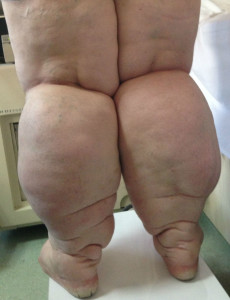 Yirmibeş yıllık çift bacak lenf ödem