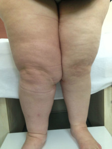 Dr.Cafer Abbasoğlu'nun 17 yıllık lenf ödem hastası