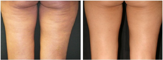 thermage_cellulite